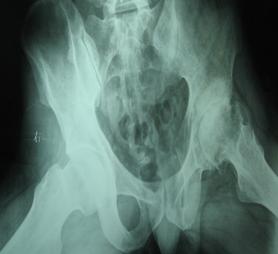 �ɹ�ͷ�����Ĳ���