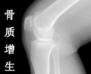 骨质增生患者要如何保养